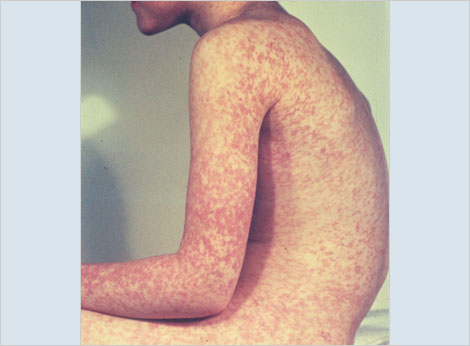 child with measles rash